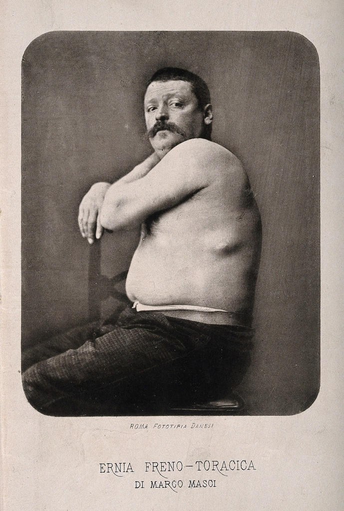 bare-chested man displays hernia, is